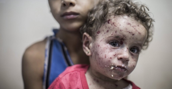 Menina ferida em ataque israelense (Oliver Weiken/EFE)