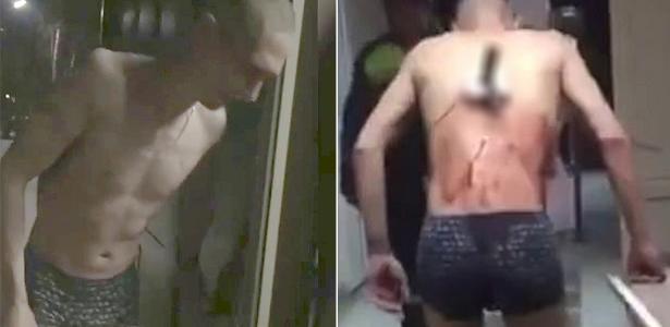 Homem tenta fugir de médicos com faca cravada nas costas na Rússia