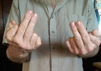 6 dedos, 2 pênis: fenômeno de órgãos extras é mais comum do que se pensa - Reprodução / Bored Panda
