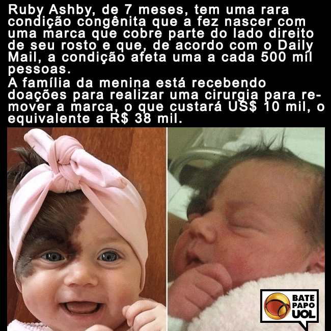 30.dez.2015 - Ruby nasceu com uma mancha no rosto e a família levanta fundos para uma operação para retirar a marca. O post teve mais de 200 curtidas