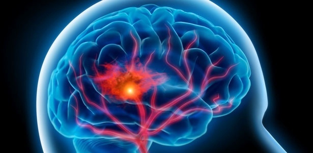 Sucesso do tratamento requer que o infarto seja diagnosticado rapidamente