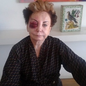 A atriz Beatriz Segall aparece com o rosto ferido após levar um tombo no Rio de Janeiro