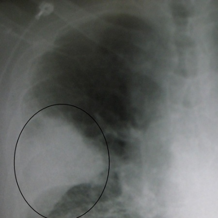Foto ilustrativa de tomografia de pulmão; ainda não há informações oficiais sobre suposto surto de doença entre crianças chinesas