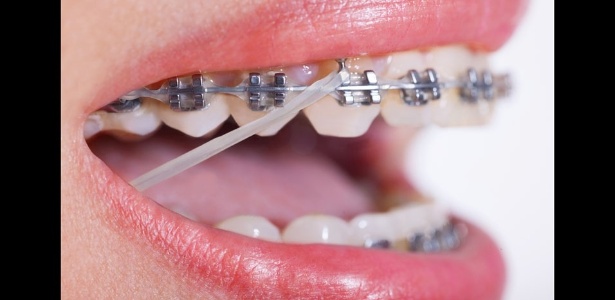 Reprodução/Orthodontics Limited Reprodução/Orthodontics Limited