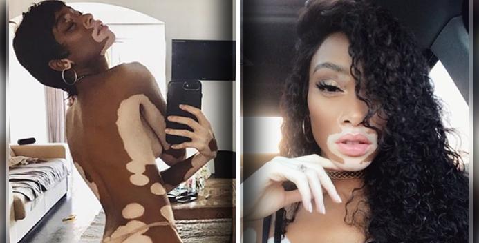 Resultado de imagem para Top com vitiligo posta nude e dá recado: "celebre sua beleza única"