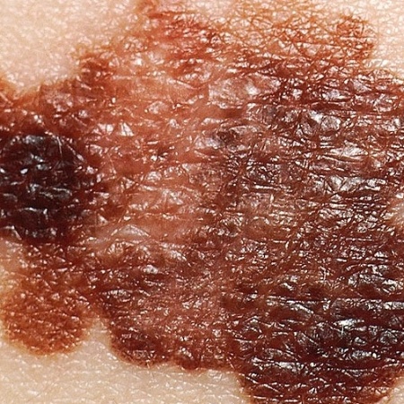 Novo tratamento contra o melanoma - Reprodução/Wikipedia