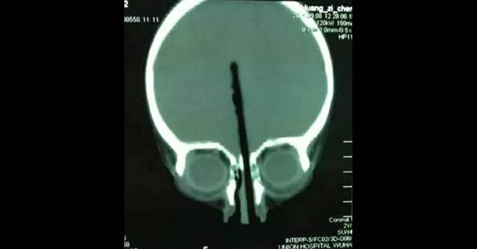 Objetos estranhos que foram encontrados em pessoas durante Raio X que te deixará desacreditado 5 5 esta crianca chinesa enfiou o palitinho de comer pelo nariz