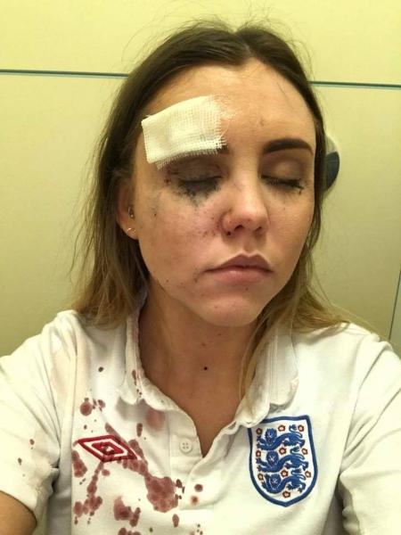Torcedora inglesa ferida por copo durante comemoração de gol contra a Colômbia - Reprodução/Facebook