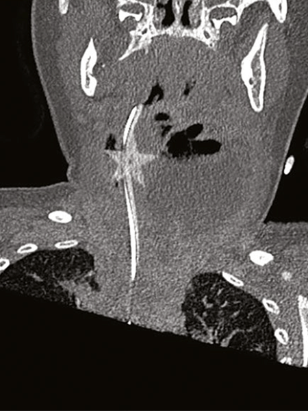 Tomografia mostra o enfeite na garganta da criança - Reprodução/The Medical Journal of Australia