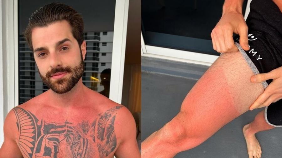Alok mostra corpo com queimaduras de sol e reclama: "Sou um idiota" - Reprodução/Instagram