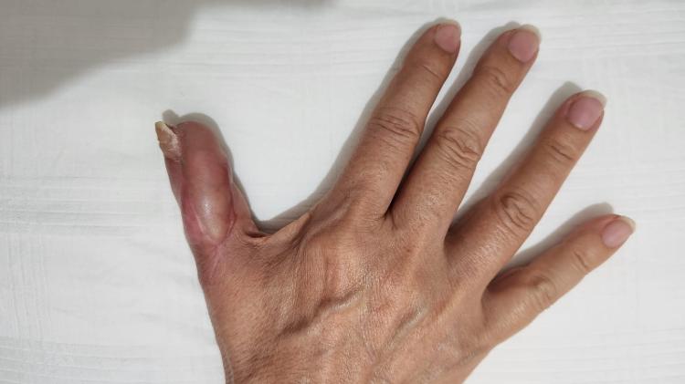 Mão de Marise atualmente, após quatro cirurgias e livre de infecção Mão de Marise atualmente, após quatro cirurgias e livre de infecção
