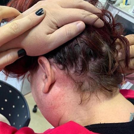 Marcas da agressão sofrida pela médica obstetra Scilla Lazzarotto em Pelotas (RS) - Arquivo pessoal