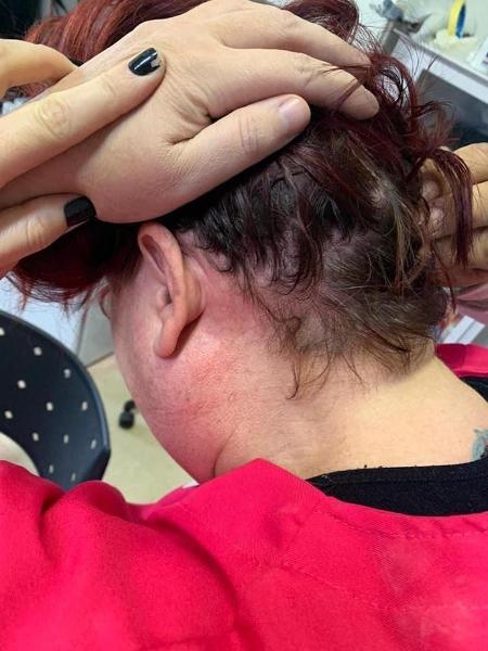 Marcas da agressão sofrida pela médica obstetra Scilla Lazzarotto em Pelotas (RS) - Arquivo pessoal