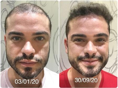 Sidney Sampaio Mostra Antes E Depois De Transplante Capilar Evolucao