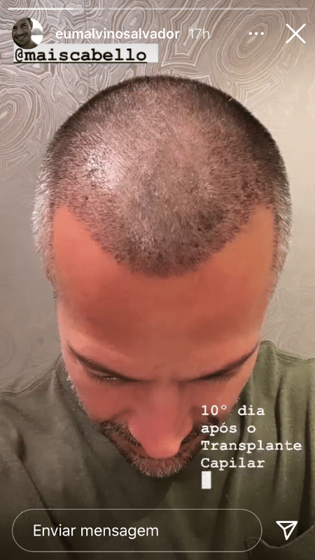 Malvino Salvador mostrou a evolução do transplante capilar nas redes sociais - Reprodução/Instagram - Reprodução/Instagram