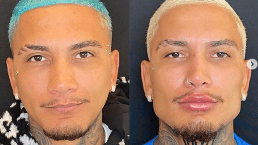 Dynho Alves mostra antes e depois de harmonização facial - Reprodução/Instagram