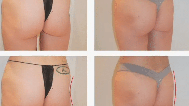 Paciente optou pelo procedimento com a AlloClae em outubro de 2025