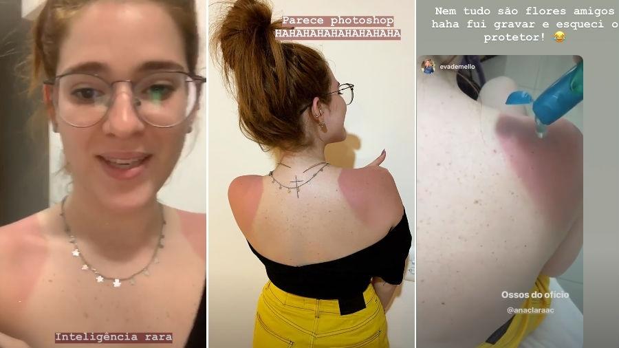 Ana Clara mostra queimadura de sol - Reprodução/Instagram
