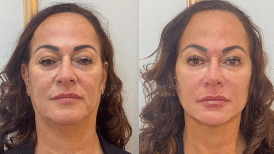 Nadine Gonçalves: antes e depois de harmonização facial - Reprodução/Instagram/@jkesteticaavancada