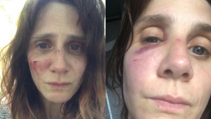Judith Chemla publicou fotos com o rosto machucado e confessou agressões que sofreu - Reprodução/Instagram