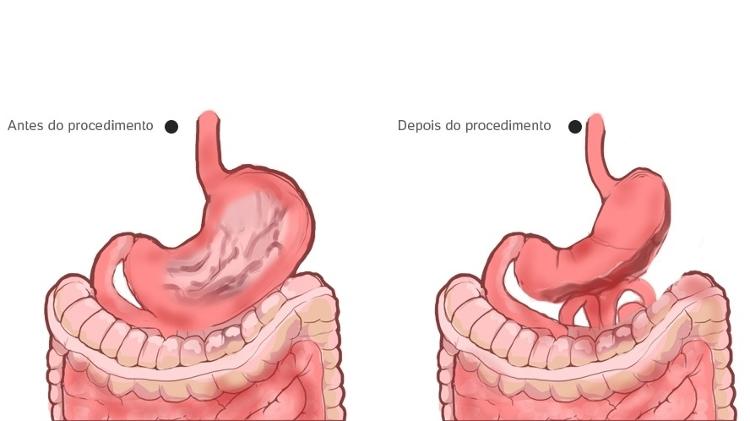 Nova bariátrica - Arte/UOL - Arte/UOL