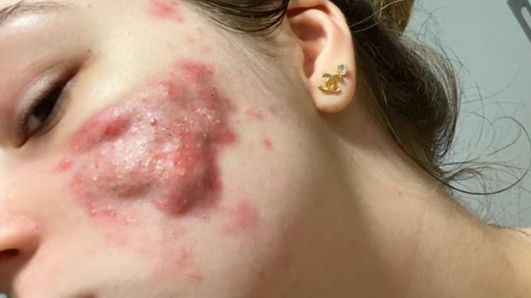 Rosto da Letícia com o uso de isotretinoína Rosto da Letícia com o uso de isotretinoína