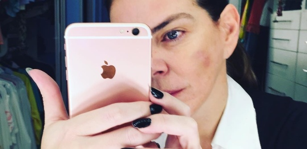 Gisele Fraga mostra rosto machucado e denuncia agressão de ex-marido - Reprodução/Instagram/giselecfraga