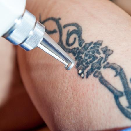 Tatuagens podem ser removidas com laser - iStock
