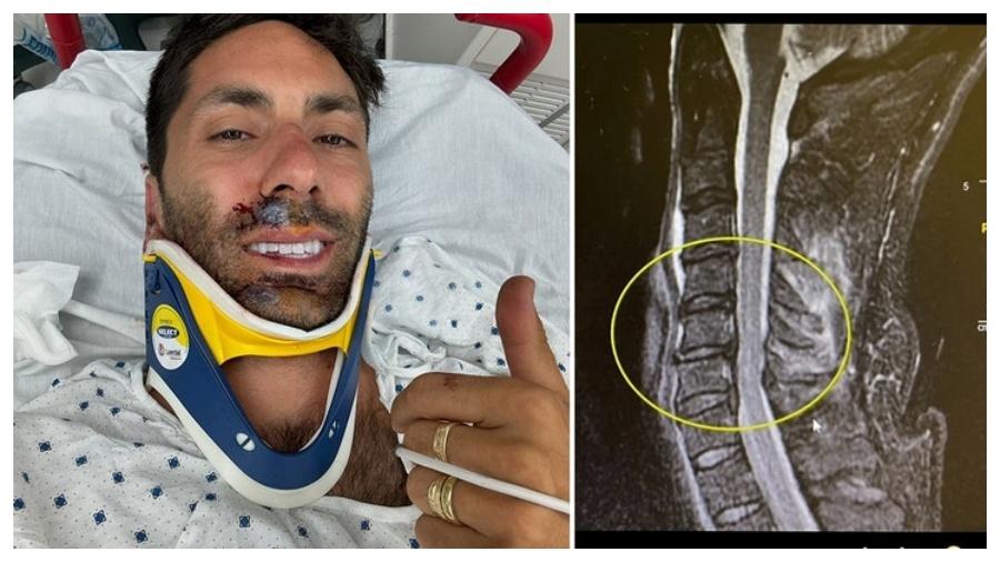 Nev Schulman quebrou o pescoço ao sofrer acidente de bicicleta