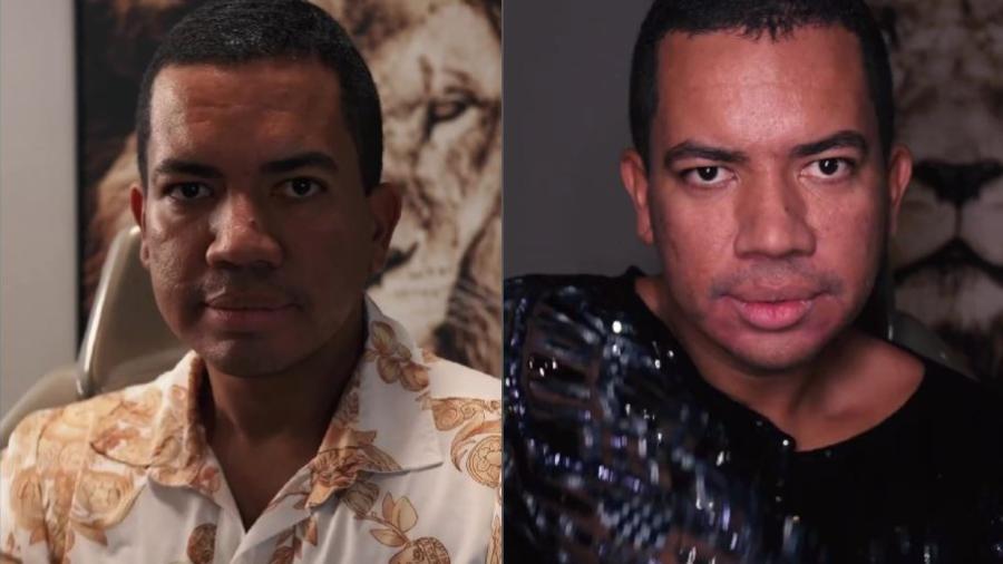 O que acharam do antes e depois da harmonização do @brunodiferente