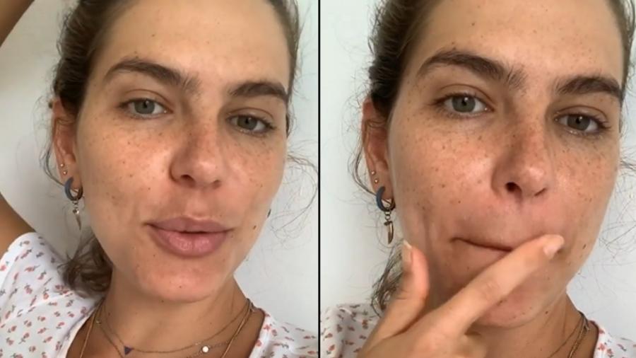 Mariana Goldfarb mostra melasmas no rosto - Reprodução/Instagram
