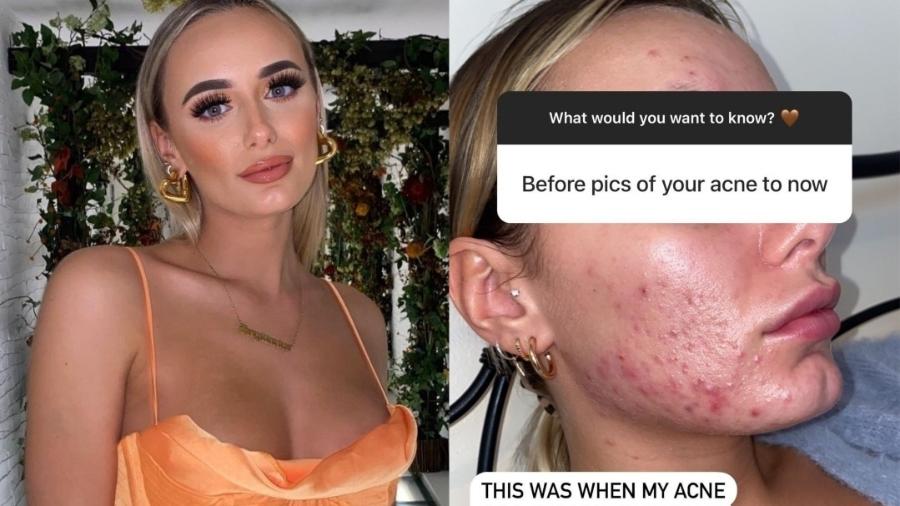Millie Court fala sobre luta contra acnes - Reprodução/Instagram