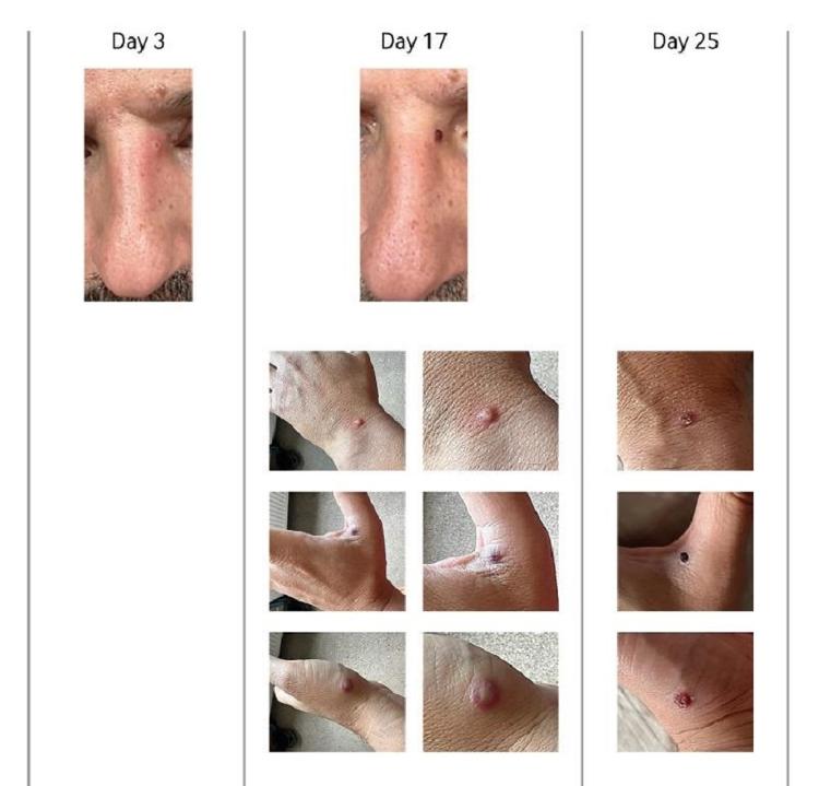 lesões - Reprodução/Periódico British Medical Journal - Reprodução/Periódico British Medical Journal