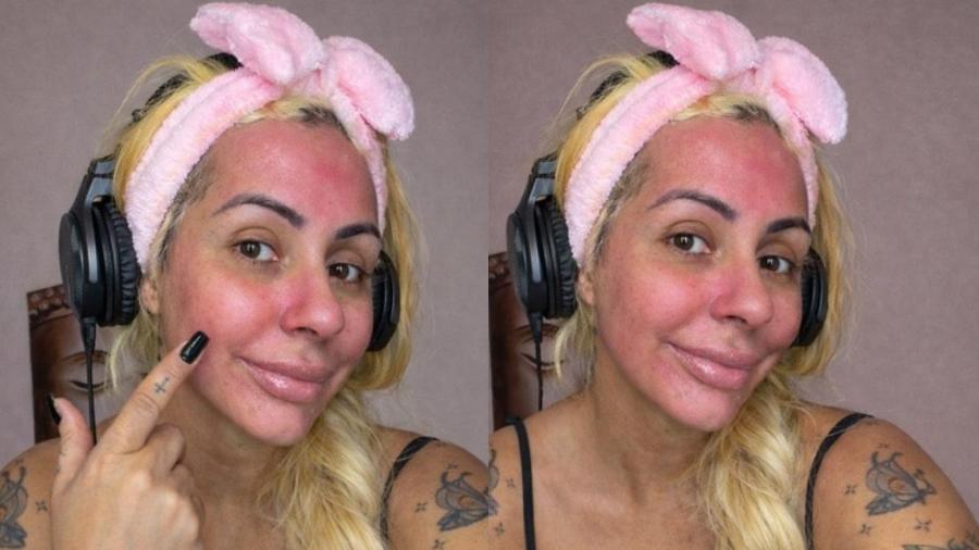 Ex-Miss Bumbum tem rea&ccedil;&atilde;o al&eacute;rgica ap&oacute;s usar pr&oacute;pria menstrua&ccedil;&atilde;o como skincare