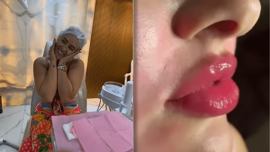 Ex-BBB Patrícia Leitte mostrou processo e resultado do preenchimento labial - Reprodução/Instagram