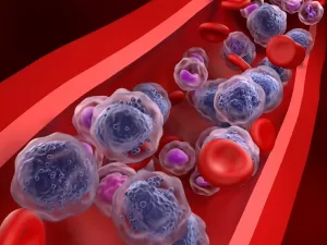 E se o exame de sangue pudesse prever quem terá leucemia mieloide aguda?