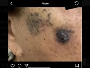 Tumor se espalha em rosto de paciente após procedimento estético; entenda