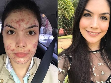 Roacutan Acne Precio