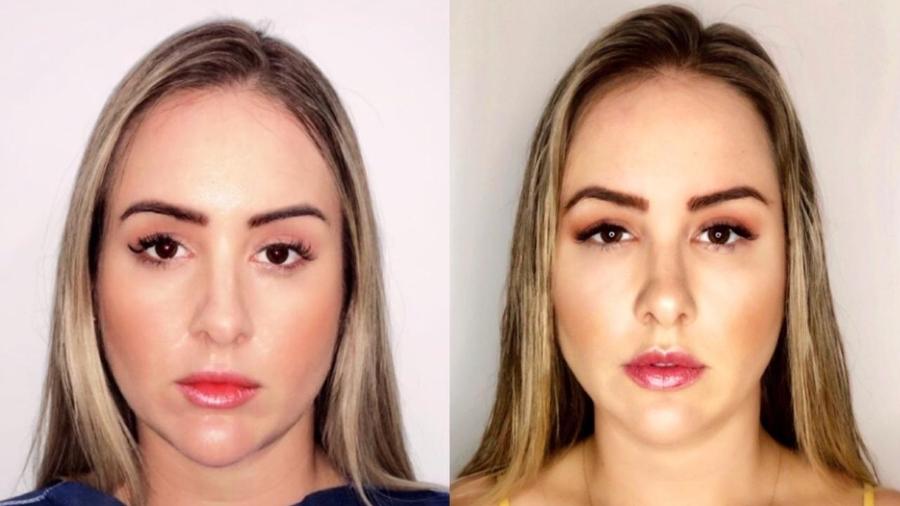 Patrícia Leitte, ex-BBB antes e depois da harmonização facial - Divulgação/Arquivo Pessoal