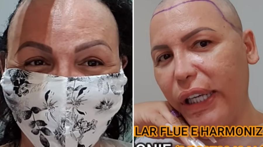 Luisa Marillac raspou a cabeça para realizar transplante capilar - Reprodução/Instagram