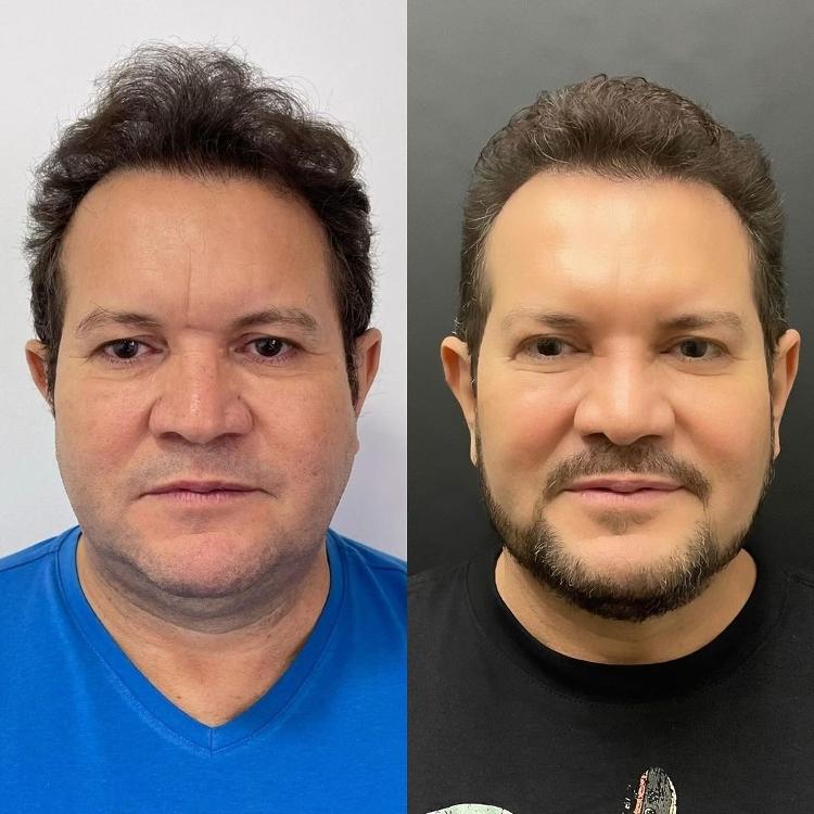 Ximbinha mostra antes e depois após fazer harmonização facial 