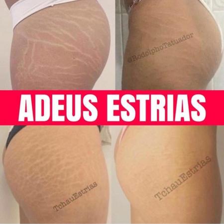 Tatuador mostra antes e depois do procedimento nas estrias - Reprodução/Facebook - Reprodução/Facebook