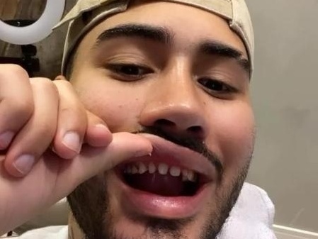 Kevinho tira lente de contato e mostra dentes desgastados; método é seguro?