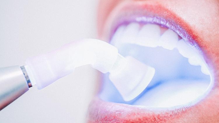 A luz azul para o clareamento dental tem sido cada vez menos usada