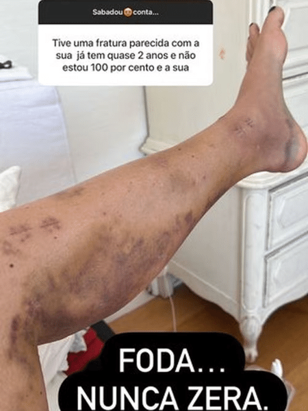 Luciana Gimenez mostra perna com hematomas, um ano após acidente de ski