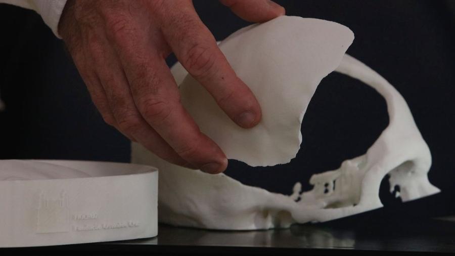 Molde e prótese de cimento ósseo para reconstrução craniana desenvolvida com tecnologia de custos reduzidos por equipe de pesquisadores multidisciplinar da Fiocruz - Fernando Frazão/Agência Brasil