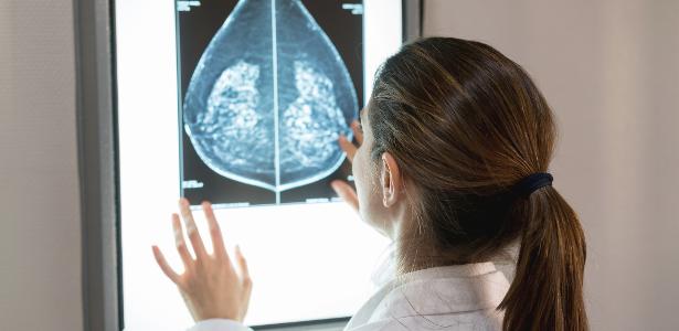 Brustkrebs betrifft immer mehr junge Menschen;  Die Studie weist auf Risikofaktoren hin