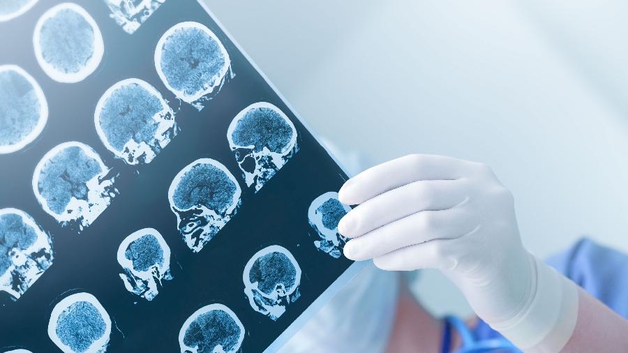 Técnica pode eliminar a necessidade de cirurgia em pacientes com tumor no cérebro - Getty Images