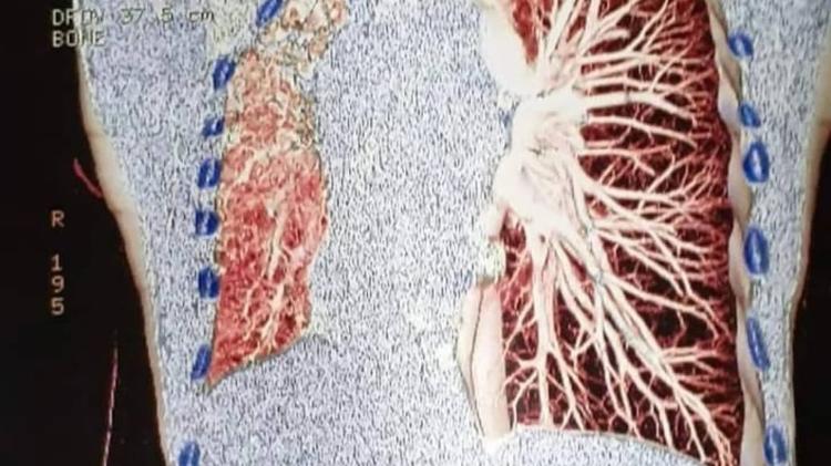 Cintilografia de Liège mostra seu pulmão transplantado (o esquerdo) à direita da imagem e o pulmão nativo (o direito) à esquerda