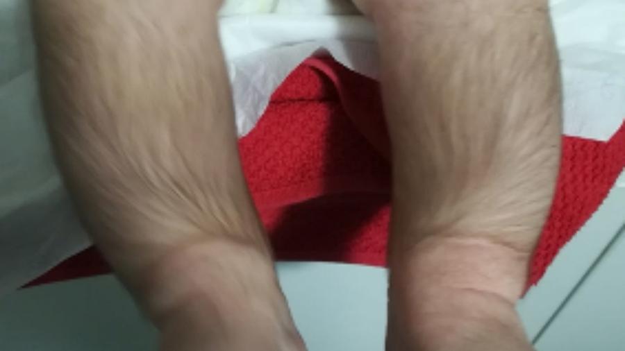 Casos de crianças com hipertricose relacionada ao uso de minoxidil pelo pai foram relatados na Europa Casos de crianças com hipertricose relacionada ao uso de minoxidil pelo pai foram relatados na Europa